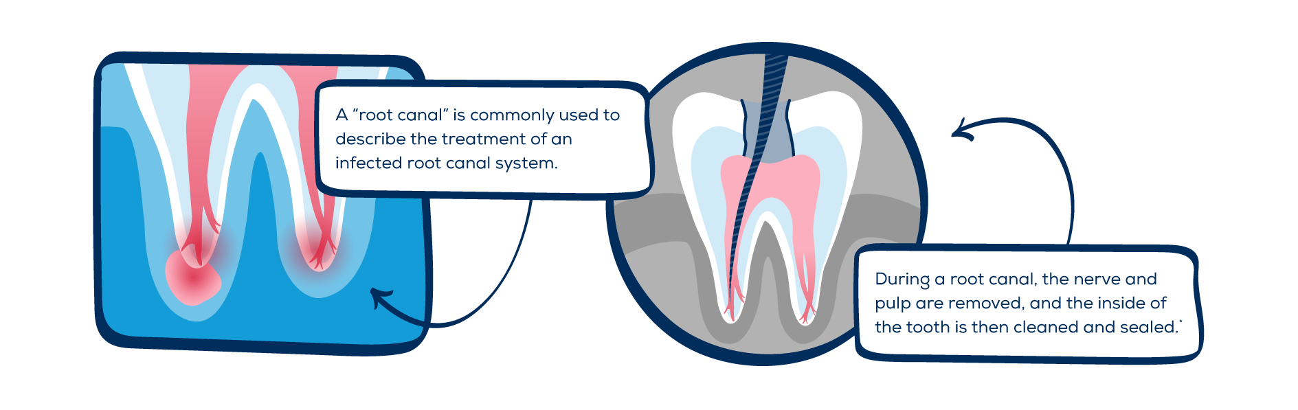 Understanding Root Canals 8 Things You Should Know